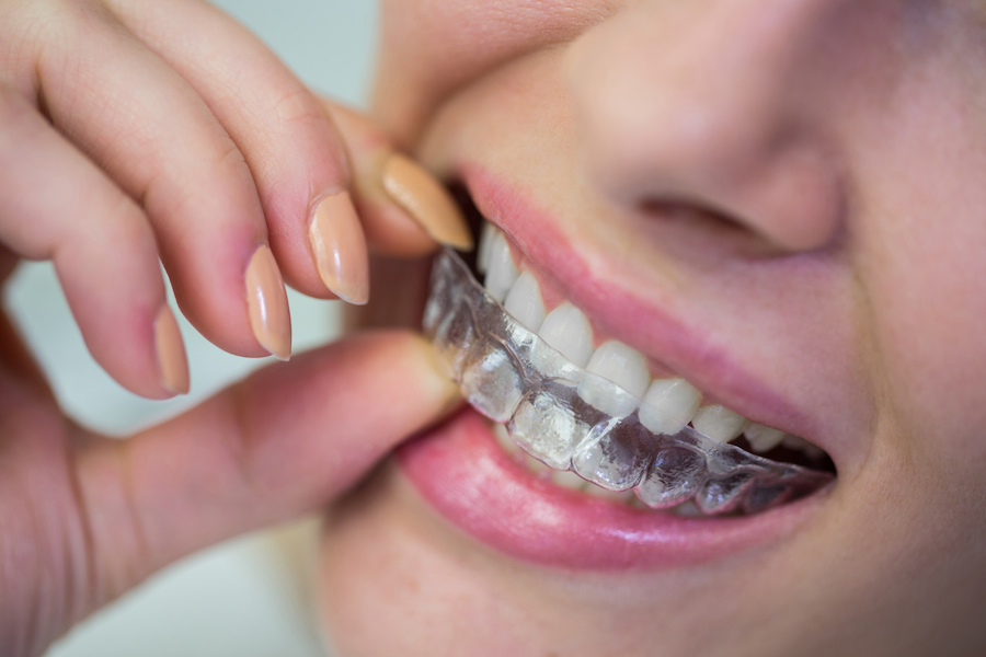 Ortodonzia invisibile a Manziana: un sorriso senza compromessi